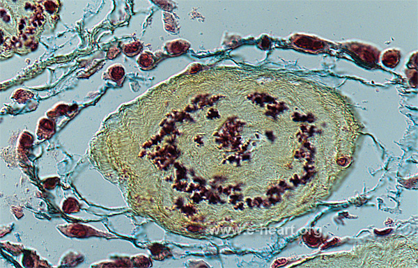 Papillary fibroelastoma High Mag Movat Stain